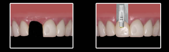 implantmodel
